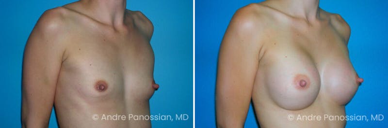 Breast Augmentation Before & After Gallery - Patient 697981 - Image 1