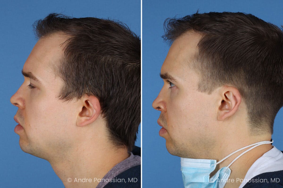 Ear Pinning (Otoplasty) Before & After Gallery - Patient 365074 - Image 5