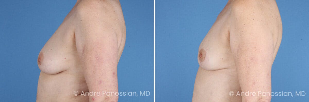 Breast Lift/Reduction Before & After Gallery - Patient 330732 - Image 5