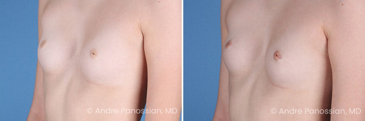 Inverted Nipple Correction Before & After Gallery - Patient 238959 - Image 2