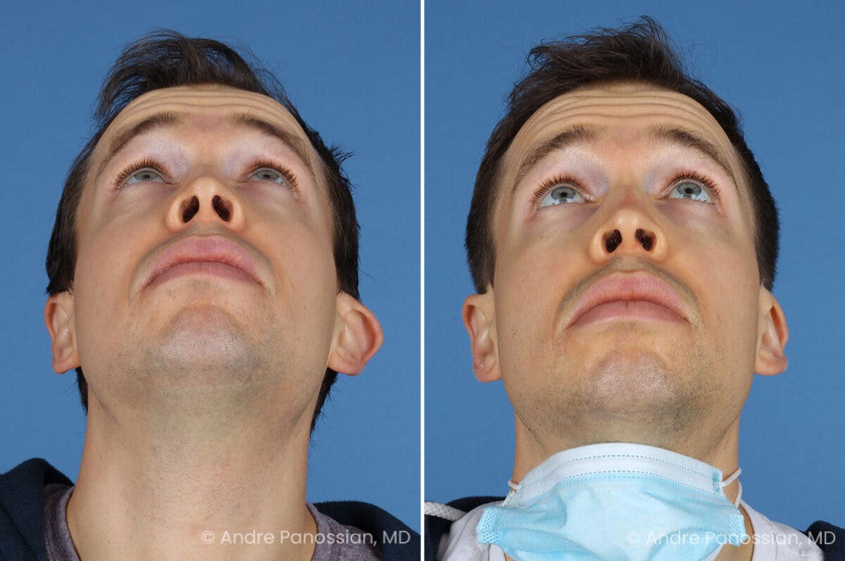Ear Pinning (Otoplasty) Before & After Gallery - Patient 365074 - Image 6