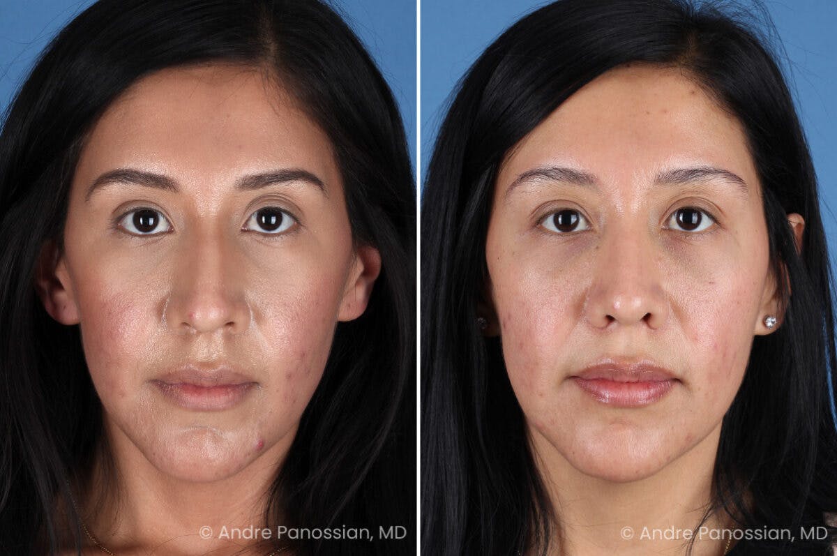 Rhinoplasty Before & After Gallery - Patient 266250 - Image 2
