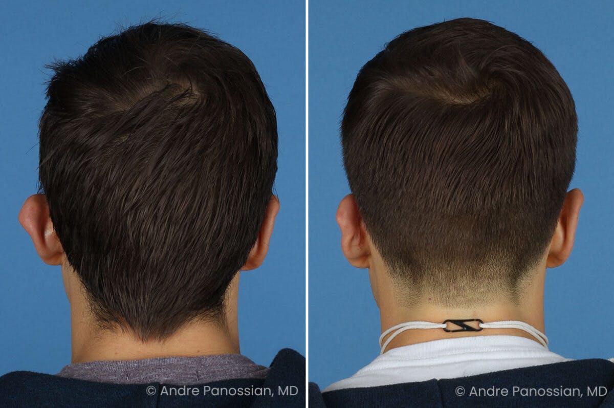 Ear Pinning (Otoplasty) Before & After Gallery - Patient 365074 - Image 7