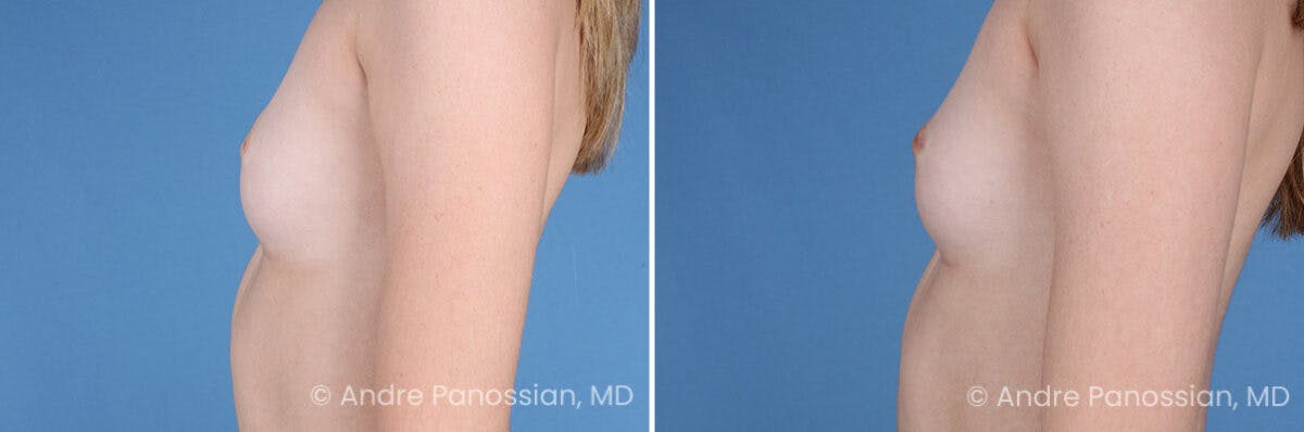 Inverted Nipple Correction Before & After Gallery - Patient 238959 - Image 3