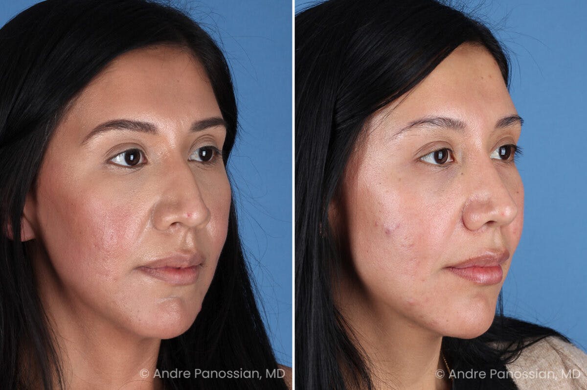 Rhinoplasty Before & After Gallery - Patient 266250 - Image 3
