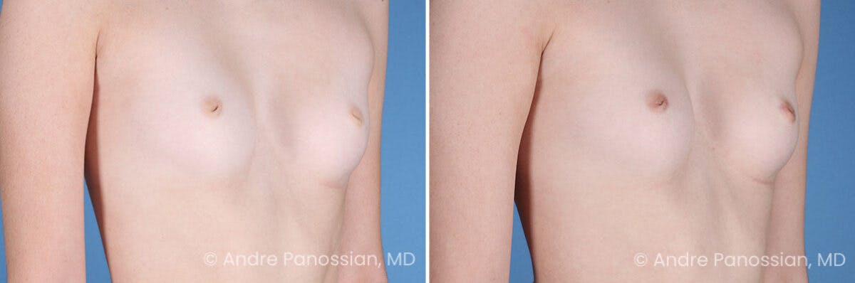 Inverted Nipple Correction Before & After Gallery - Patient 238959 - Image 4