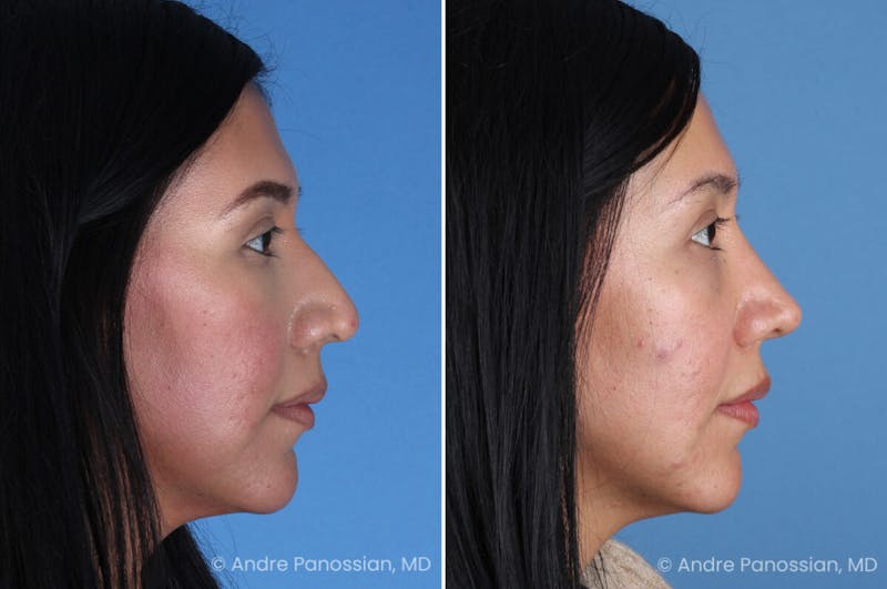 Rhinoplasty Before & After Gallery - Patient 266250 - Image 1