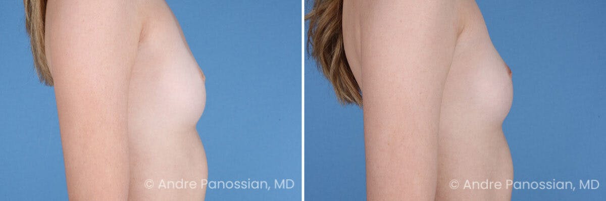 Inverted Nipple Correction Before & After Gallery - Patient 238959 - Image 5