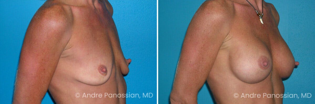 Breast Augmentation Before & After Gallery - Patient 311668 - Image 1