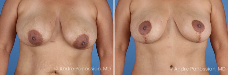 Breast Lift/Reduction Before & After Gallery - Patient 367209 - Image 1