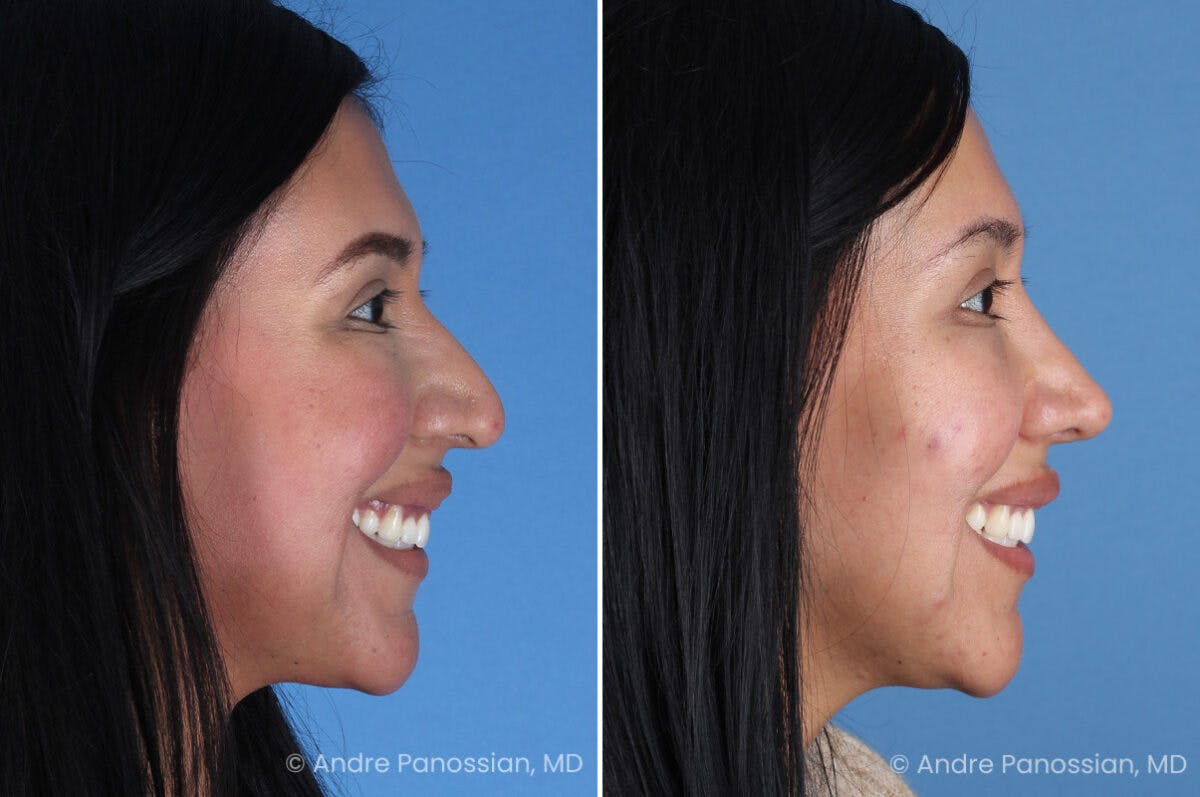 Rhinoplasty Before & After Gallery - Patient 266250 - Image 4