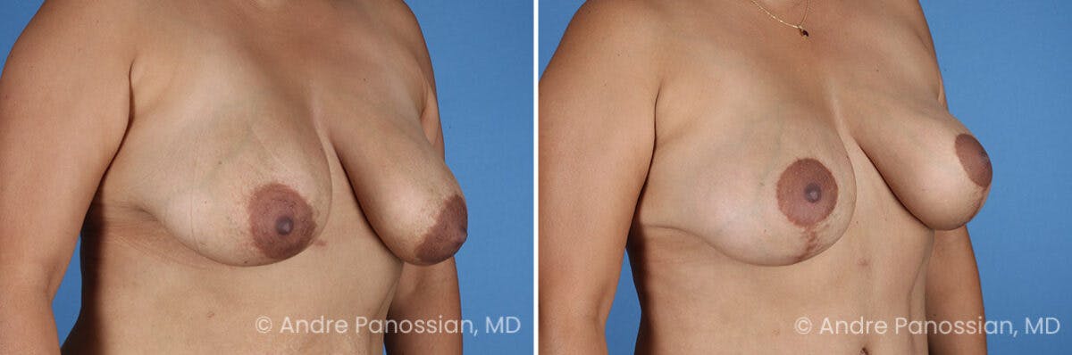 Breast Lift/Reduction Before & After Gallery - Patient 367209 - Image 2
