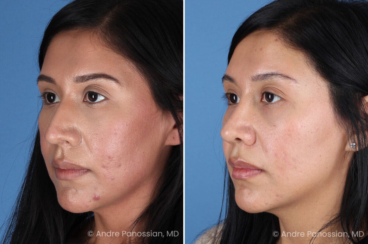 Rhinoplasty Before & After Gallery - Patient 266250 - Image 5