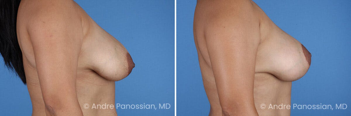 Breast Lift/Reduction Before & After Gallery - Patient 367209 - Image 3