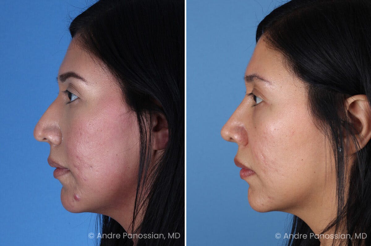 Rhinoplasty Before & After Gallery - Patient 266250 - Image 6