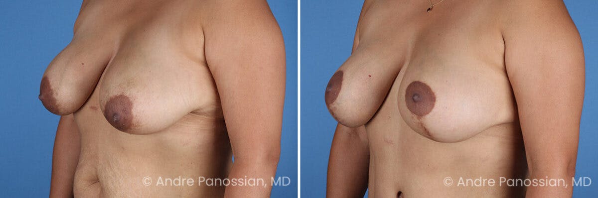 Breast Lift/Reduction Before & After Gallery - Patient 367209 - Image 4