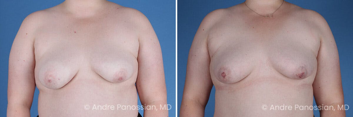 Inverted Nipple Correction Before & After Gallery - Patient 265926 - Image 1