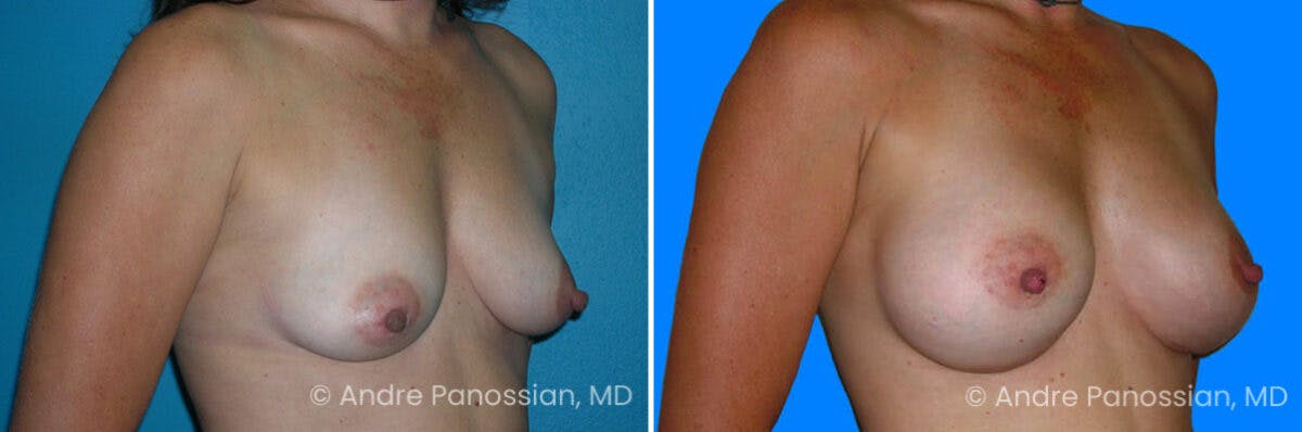 Breast Augmentation Before & After Gallery - Patient 301684 - Image 1