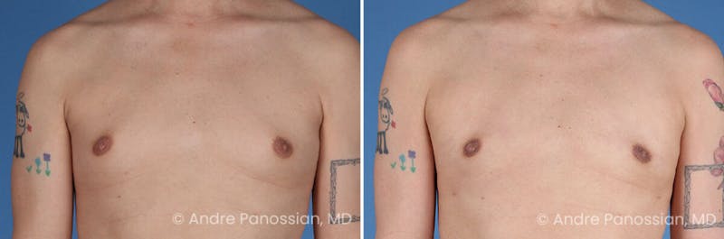 Male Breast Reduction (Gynecomastia) Before & After Gallery - Patient 367995 - Image 1
