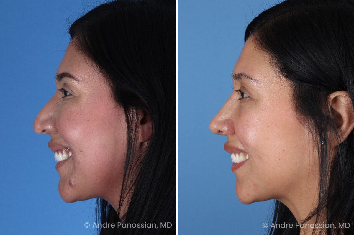 Rhinoplasty Before & After Gallery - Patient 266250 - Image 7