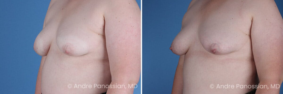 Inverted Nipple Correction Before & After Gallery - Patient 265926 - Image 2
