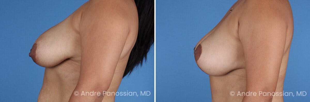 Breast Lift/Reduction Before & After Gallery - Patient 367209 - Image 5