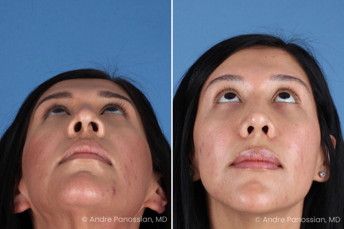 Rhinoplasty Before & After Gallery - Patient 266250 - Image 8