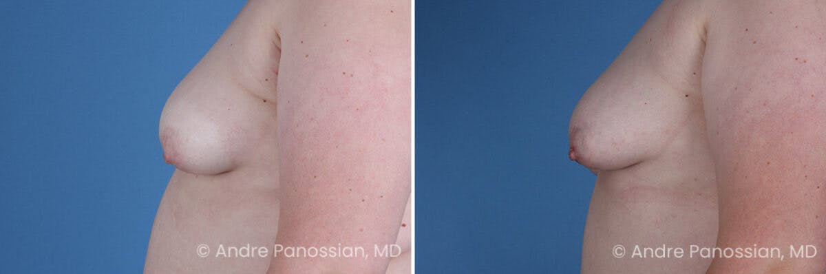 Inverted Nipple Correction Before & After Gallery - Patient 265926 - Image 3