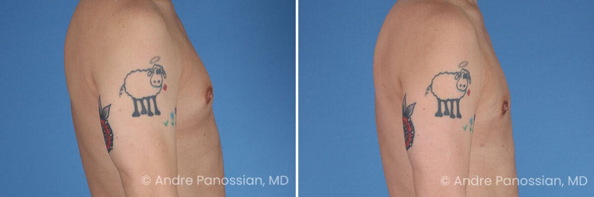 Male Breast Reduction (Gynecomastia) Before & After Gallery - Patient 367995 - Image 3