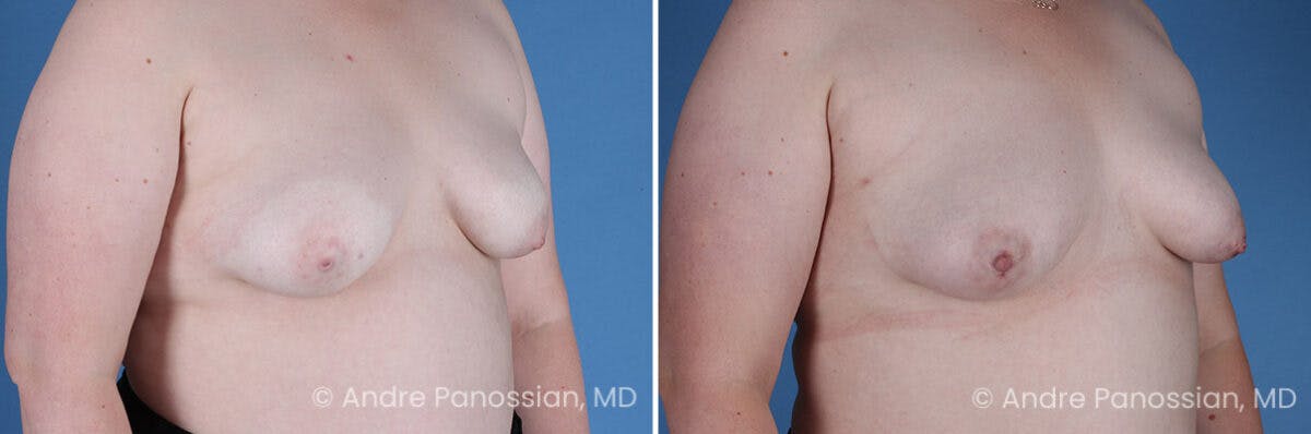 Inverted Nipple Correction Before & After Gallery - Patient 265926 - Image 4