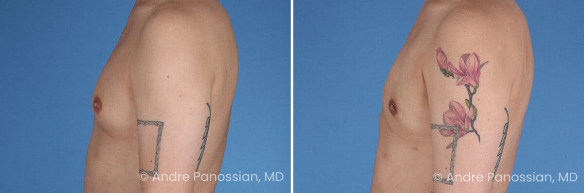 Male Breast Reduction (Gynecomastia) Before & After Gallery - Patient 367995 - Image 4