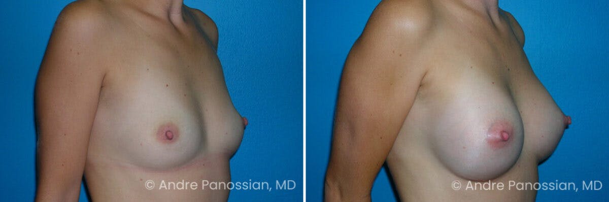 Breast Augmentation Before & After Gallery - Patient 314959 - Image 1