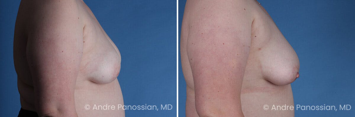 Inverted Nipple Correction Before & After Gallery - Patient 265926 - Image 5