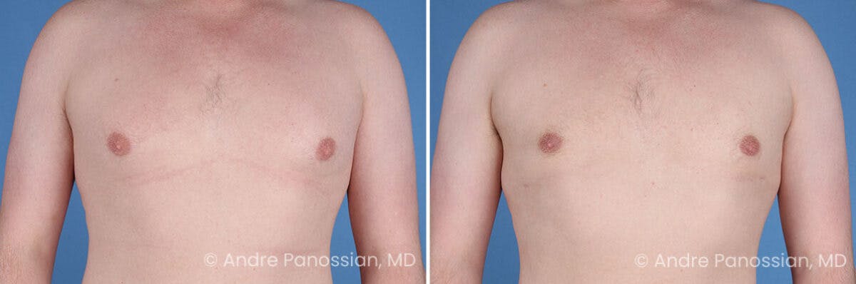 Male Breast Reduction (Gynecomastia) Before & After Gallery - Patient 228734 - Image 1