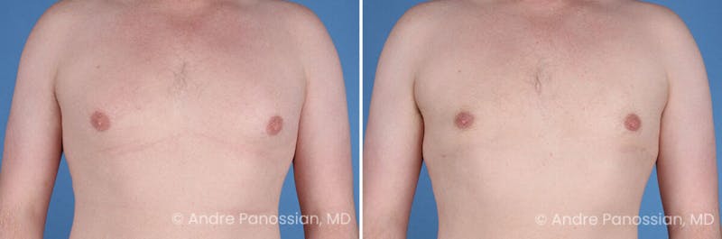 Male Breast Reduction (Gynecomastia) Before & After Gallery - Patient 228734 - Image 1
