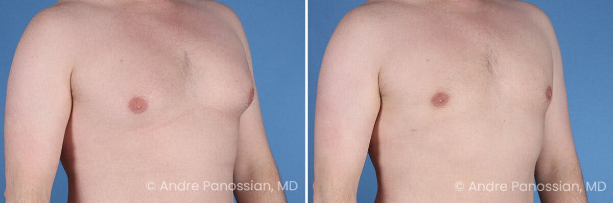 Male Breast Reduction (Gynecomastia) Before & After Gallery - Patient 228734 - Image 2