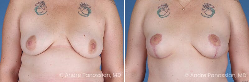 Breast Lift/Reduction Before & After Gallery - Patient 116305 - Image 1
