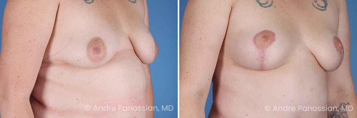 Breast Lift/Reduction Before & After Gallery - Patient 116305 - Image 2
