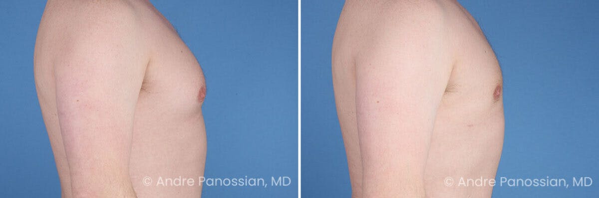 Male Breast Reduction (Gynecomastia) Before & After Gallery - Patient 228734 - Image 3