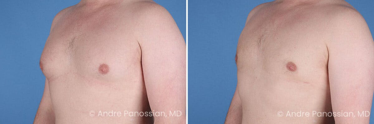Male Breast Reduction (Gynecomastia) Before & After Gallery - Patient 228734 - Image 4