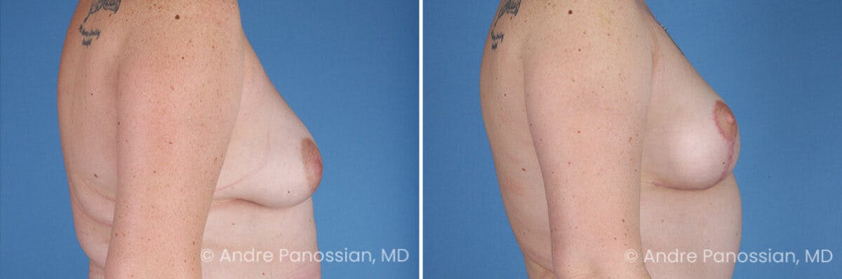 Breast Lift/Reduction Before & After Gallery - Patient 116305 - Image 3