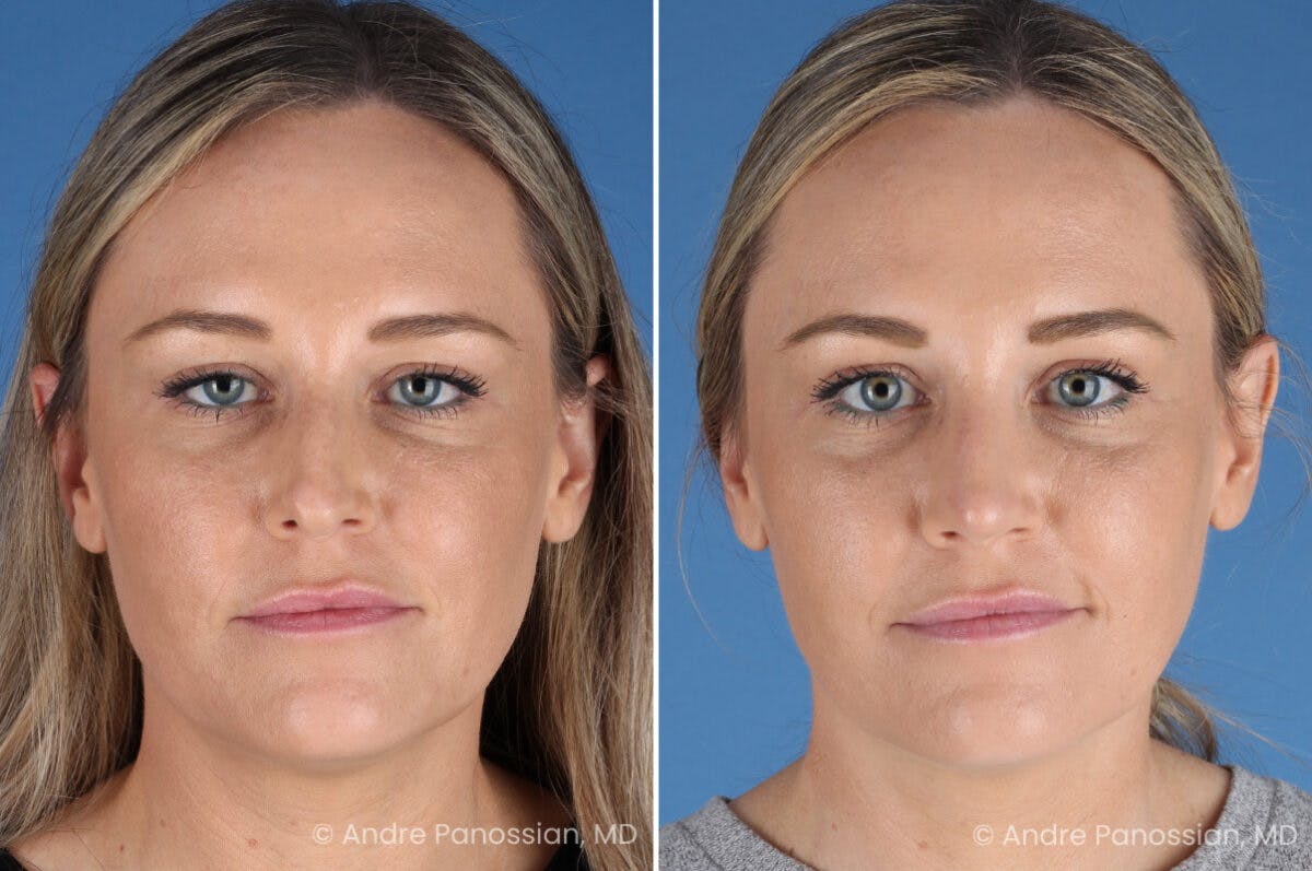 Rhinoplasty Before & After Gallery - Patient 103326 - Image 2
