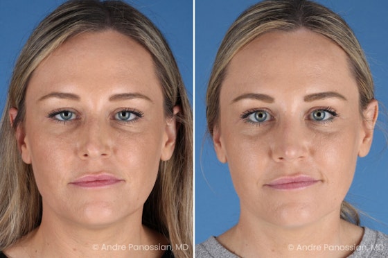 Rhinoplasty before and after — actual patient of Andre Panossian, MD