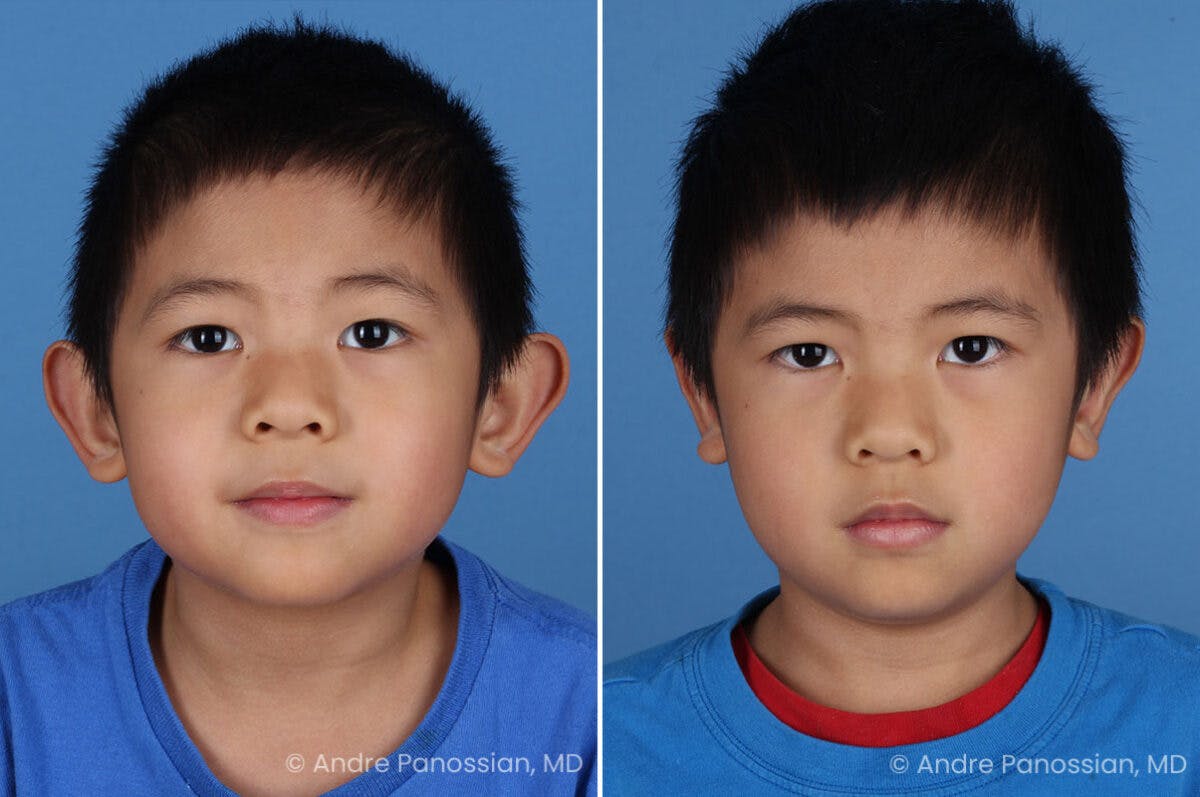 Ear Pinning (Otoplasty) Before & After Gallery - Patient 637268 - Image 1