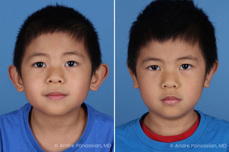 Ear Pinning (Otoplasty) Before & After Gallery - Patient 637268 - Image 1