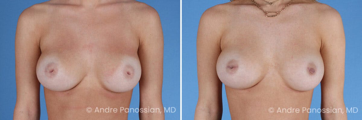 Inverted Nipple Correction Before & After Gallery - Patient 295469 - Image 1