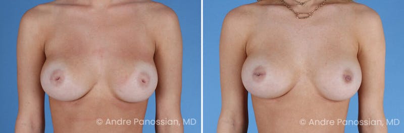 Inverted Nipple Correction Before & After Gallery - Patient 295469 - Image 1