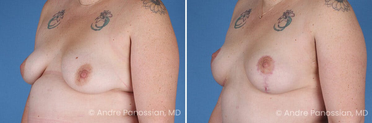 Breast Lift/Reduction Before & After Gallery - Patient 116305 - Image 4