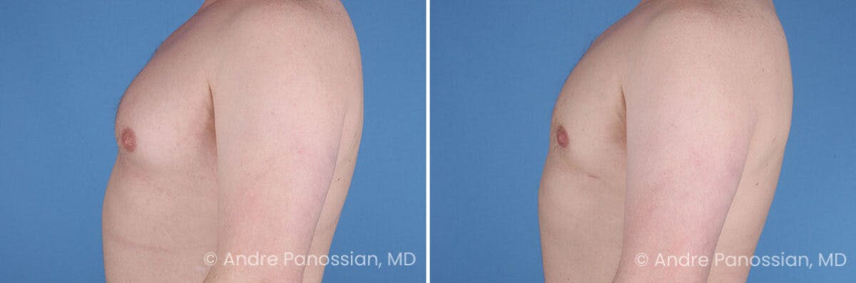 Male Breast Reduction (Gynecomastia) Before & After Gallery - Patient 228734 - Image 5