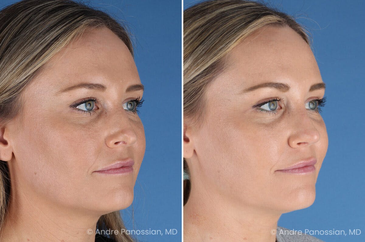 Rhinoplasty Before & After Gallery - Patient 103326 - Image 3